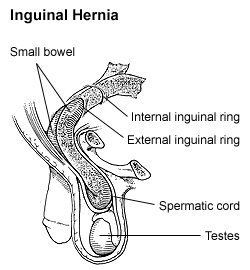 Hernia : what is it and who to care treat