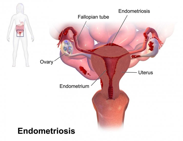 Treatment for Endometriosis and Facts, FAQs, and an Overview about Endometriosis
