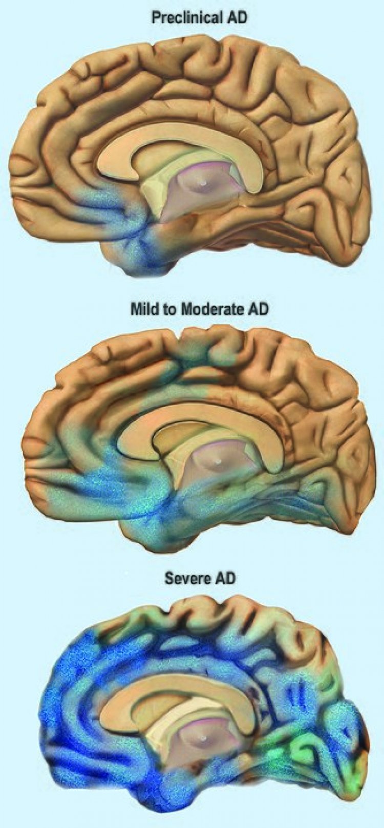Know the Early, Middle and Last Stages and Late Stage of Alzheimers Desease