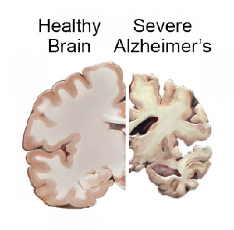 How does Alzheimer's disease affect the brain?